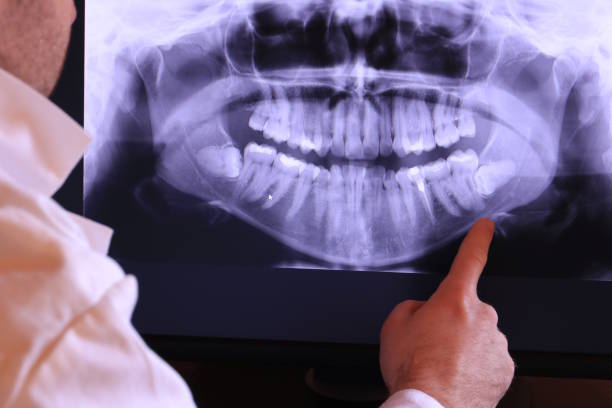 Best Emergency Treatment for Dental Infections or Abscesses in Brentwood, NY